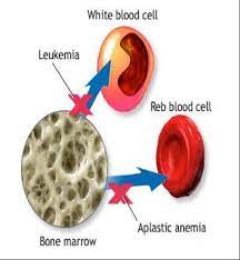 Aplastic Anemia The Oncofertility Consortium