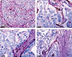 Cancer biology goes under the microscope this week, as gerard evan talks about the causes of cancer and how cancer spreads around the body. The Identification Of Vm In Invasive Breast Cancer Specimens A And Download Scientific Diagram