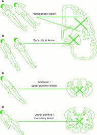 Neurological Assessment Of Coma Journal Of Neurology Neurosurgery Psychiatry