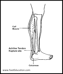 It plantarflexes at the ankle joint, and because it the soleus is located deep to the gastrocnemius. Achilles Tendon Rupture Orthopaedia