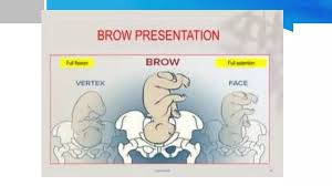 Image result for Brow Presentation