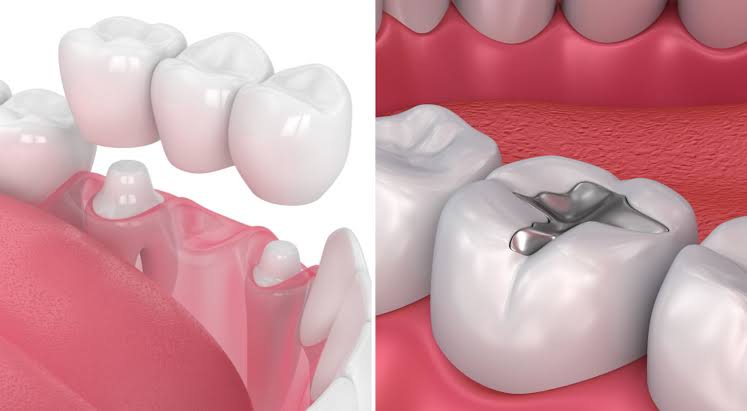 Dental Fillings and Restoration