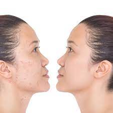How to use tretinoin for acne. Tretinoin Before And After How Long Does It Take To Work Roman Healthguide