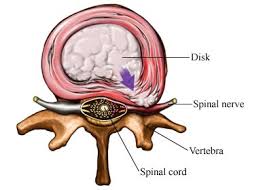 A slipped disc is like squeezing a jam doughnut: Bulging Disc Spinecare Chiropractic Adelaide Chiropractors