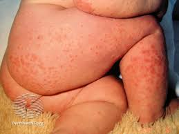 Image result for Papular Acrodermatitis