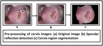 Cervical cancer can be easily detected if you conduct regular pap smear tests. Detection Of Specular Reflection And Segmentation Of Cervix Region In Uterine Cervix Images For Cervical Cancer Screening Sciencedirect