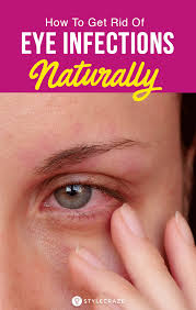 10 Proven Home Remedies For Eye Infections Eye Infections Eye Infection Treatment Eye Infection Symptoms