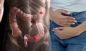 Bowel cancer is sometimes called colon or rectal cancer. Bowel Cancer If You Experience Any Of These Four Signs It Could Be A Warning Sign Express Co Uk
