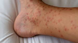 Hives (Urticaria): Causes, Pictures, Treatments, And Symptoms