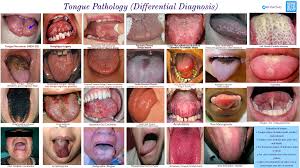 Image result for Fissured tongue