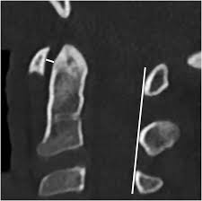 Tips of the spinous processes. Specifics Of Pediatric Spinal Trauma Section 5 Clinical Imaging Of Spinal Trauma