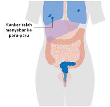 Wajar saja karena menurut data who (badan kesehatan dunia), penyakit kanker serviks ini menempati peringkat teratas penyebab. Kanker Serviks Stadium 4 Info Penting Bagi Para Penderita Kanker