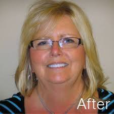 Grand Rapids Dentist Dr. Randall Chambers Satisfied Patients Before and  After