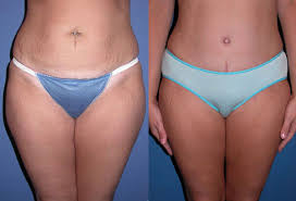 How tight should my compression garment be after liposuction? How Long Do U Wear Compression Garment After Lipo