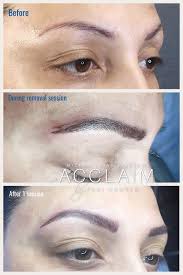 We use the latest techniques in micropigmentation. Eyebrow Tattoo Removal Arlington Microblading Removal Tx