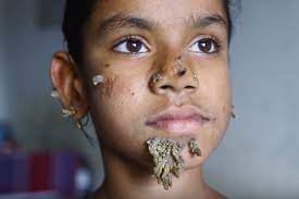 He became known when a video of. First Female To Suffer From Tree Man Syndrome Undergoes Successful Surgery