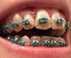 How do they treat a cavity? Cavity Below Gum Line Exposed As Teeth Have Moved Maybe Braces