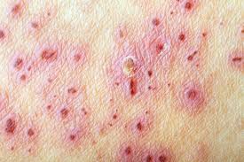 Image result for shingles
