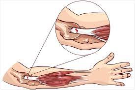 Neural or nerve stretching can release tension and help increase the benefits of other stretch exercises. Tennis Elbow Exercises
