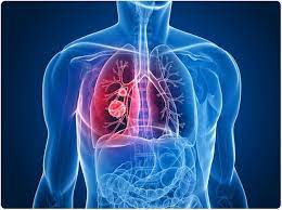 Lung cancer that has spread to the bones may cause pain at the sites of the affected bone. Recent Advancements In Lung Cancer Treatment