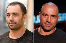 What treatments do these famous faces use for hair loss? 19 Bald Celebrities Before After Embracing Baldness