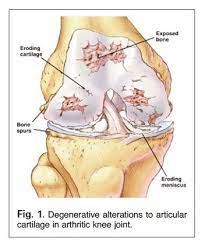 Here is a list of foods that help rebuild cartilage. Traditional Chinese Herbs For Arthritis Nutrition Review