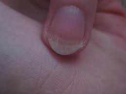 Schlechte Fingernagel Beauty Nagel