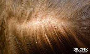 Image result for white scabs on the head in children
