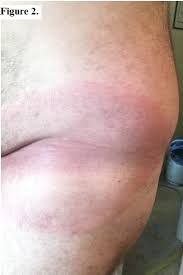 Image result for Lyme Carditis