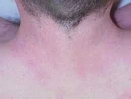 Specialized services include general and surgical dermatology for adults and children, numerous laser and light. Laser Hair Removal San Jose Palo Alto Carmel Ca Korman Plastic Surgery