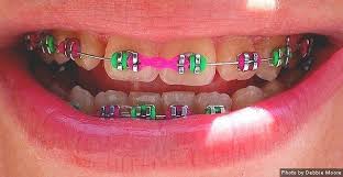 Black And Blue Braces Together Different Braces Colors Braces Colors Green Braces Teeth Braces