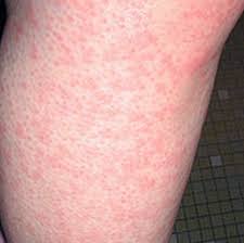 Pin On Heat Rash