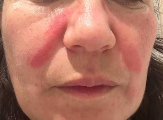 I have sore and irritaed skin from my S10 CPAP machine. Any advice ? Do I  just need to replace my cushion pad or mask liner ? Thanks