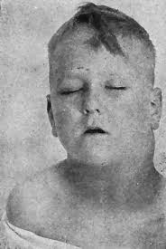 File:Hodgkin's Disease (Essentials of Medicine).jpg