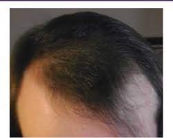 Dihydrotestosterone (known as dht), a hormone that your body produces as a byproduct of testosterone. Figure 3 From Scalp Hair Regrowth In Hormone Treated Transgender Woman Semantic Scholar