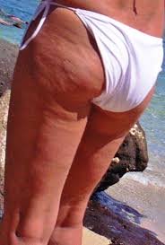 They try hard to make it up through. Cellulite Wikipedia