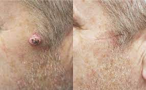 Learn more about targeted therapy, surgery, and chemotherapy. Private Skin Cancer Treatment Skin Surgery Clinic