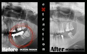 Cu ajutorul lor se pot evidenția carii, leziuni la nivelul rădăcinilor dentare, dinți incluși, pierderi din masa osoasă care susține dintele, toate. RomanÄƒ Dental Design