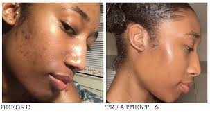 Hyperpigmentation can also be caused by various drugs. African American Acne Hyperpigmentation Before And After Laser Facial Acne Hyperpigmentation All Things Beauty