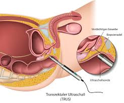 Prostatakrebs Prostatakarzinom Ursachen Haufigkeit Und Behandlung