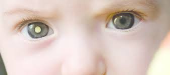 Find the latest news and information about eye cancer in our knowledge center, including blog posts, articles, videos, news releases and more. Seen A White Glow In A Photo Childhood Eye Cancer Trust