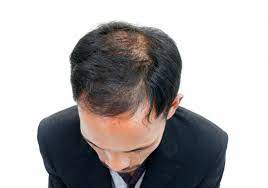 In case you are also affected by hair breakage, apple cider vinegar can be the jackpot for you. Seven Natural Ways To Get Thicker Hair