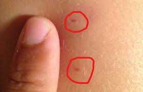 We did not find results for: Do Dust Mites Bite Pictures On Human Allergy Signs Get Rid Prevent Pestbugs