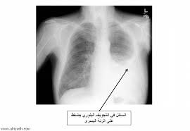 ما اسباب تجمع الماء على الرئة علاج حالات ياس منها الطب اجمل بنات