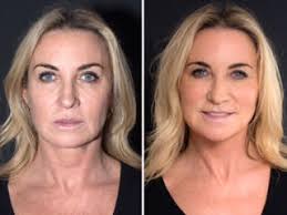 Check out nurse jamie on e news demonstrate the amazing results of a thread lift!check out our spa: Star Treatment Meg Matthews Before After Silhouette Soft Thread Lift Save Face