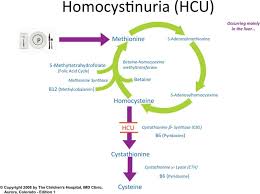 Image result for Homocystinuria