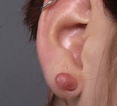Keloids From Piercings