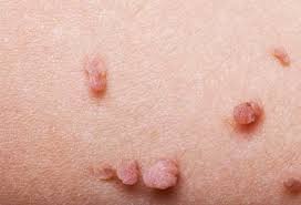 Image result for sore skin in the groin area