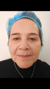 #técnicaminimalpoints #armonizacionfacial #tallerfillers , Con la técnica  Minimal points para armonizacion facial obtenemos resultados más naturales  utilizando menos jeringas de ácido hialurónico y ...