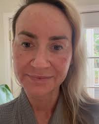 When you're ready for that next-level result and can commit to the journey…  DEKA CO₂ has officially entered the chat. Think our gentle CoolPeel CO₂,  but multiply the results fivefold. This isn't